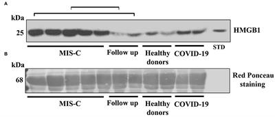 HMGB1 in Pediatric COVID-19 Infection and MIS-C: A Pilot Study